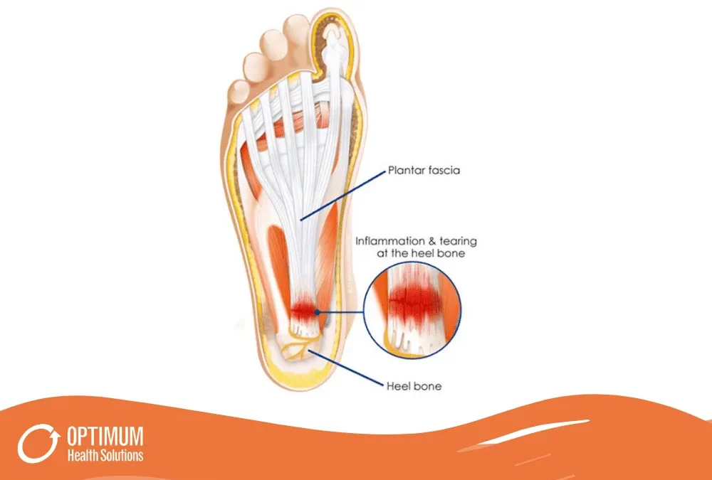can dry needling help plantar fasciitis