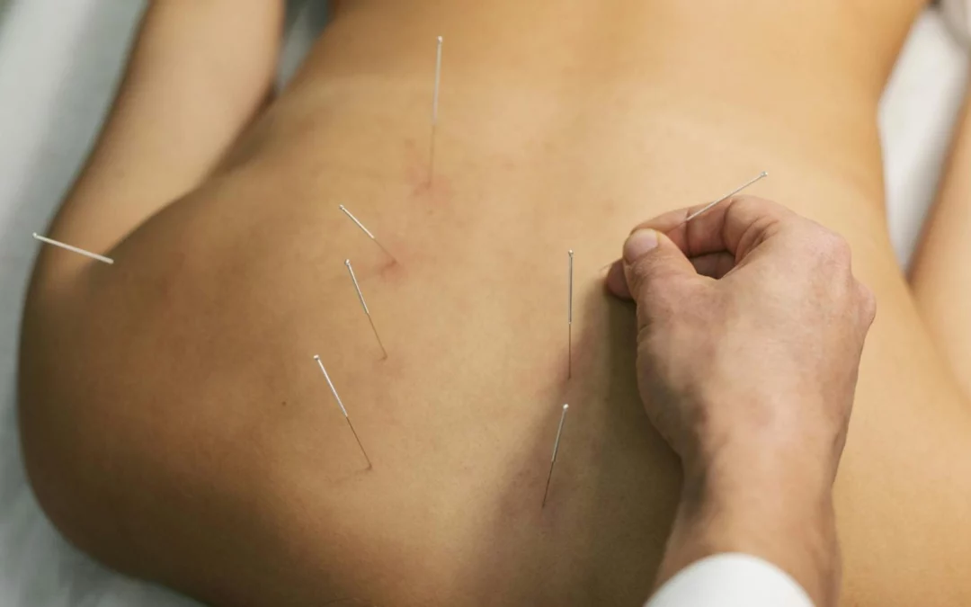 Dry Needling for Hip Flexor Pain
