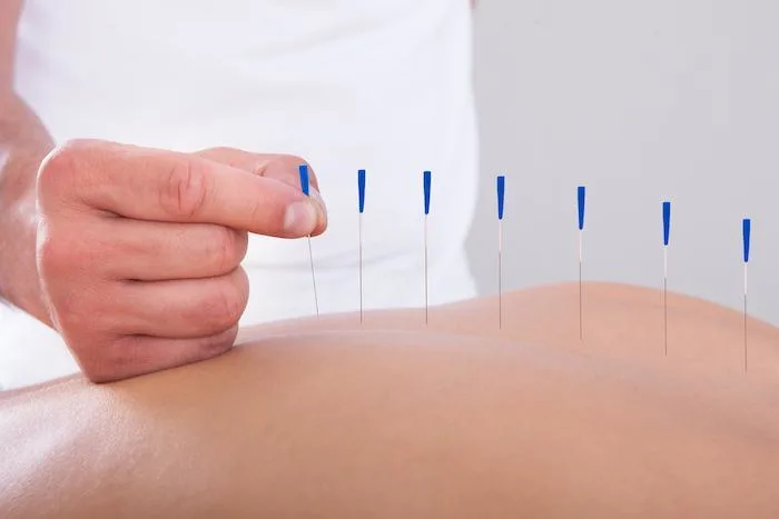 What Happens When Dry Needling Hits a Nerve