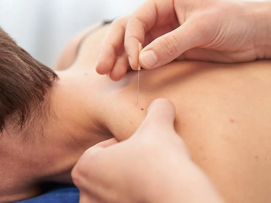 What Is Dry Needling
